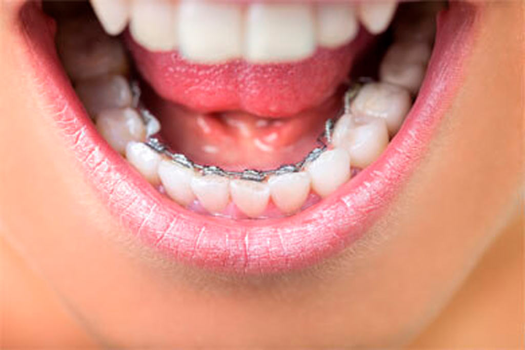 Tratamiento ortodoncia lingual